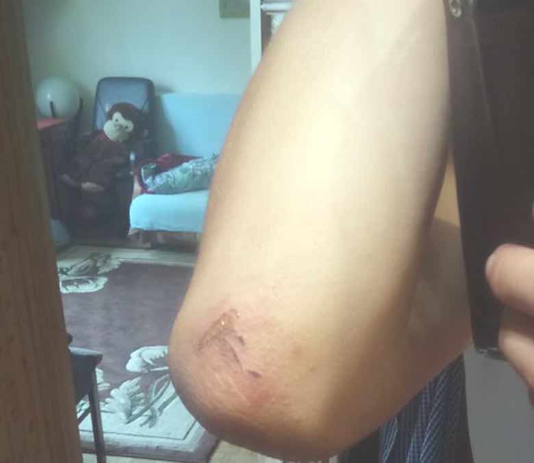 scratch elbow after Saab accident